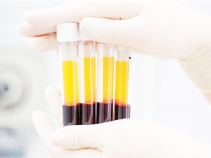 Ứng dụng tiểu cầu tự thân trong điều trị vô sinh